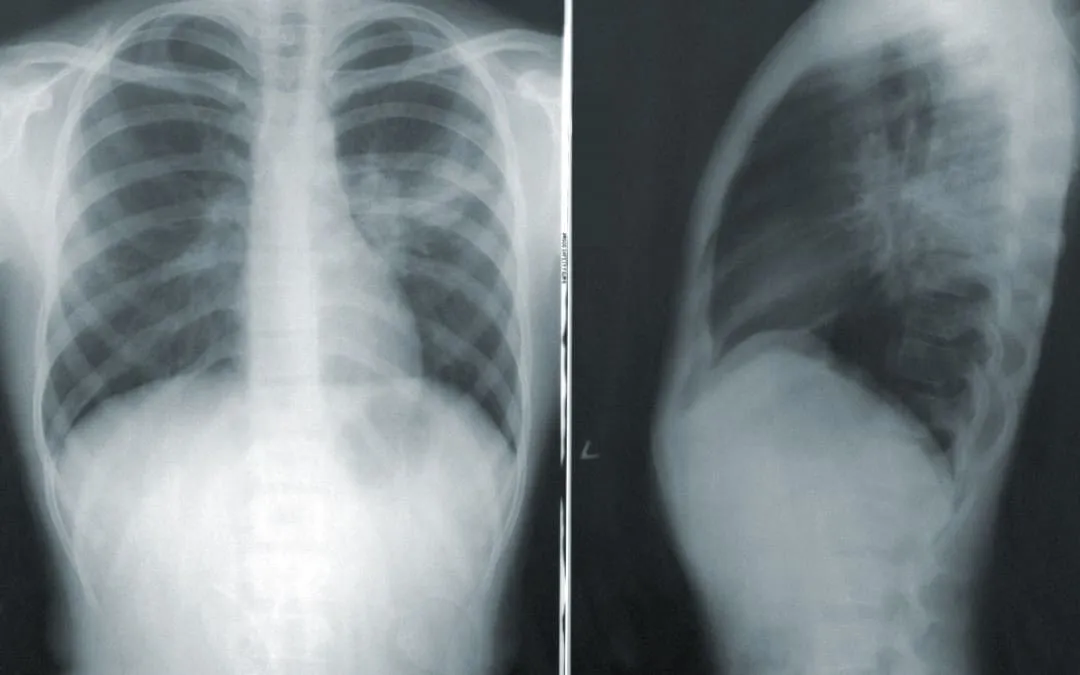 Social Security Disability and Respiratory Disorders