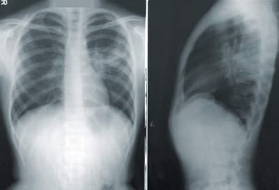 Social Security Disability and Respiratory Disorders